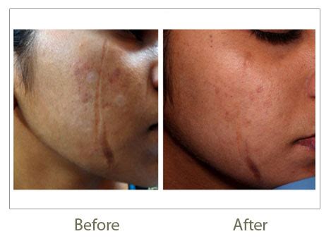 Fractional CO2 Laser | Laser Skin Resurfacing | Skin Laser Treatment