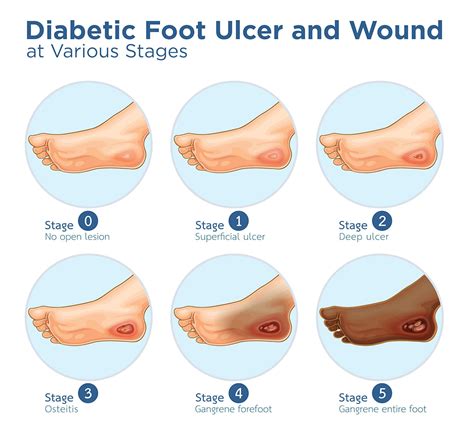 Bangkok Post Understanding Diabetic Foot Ulcers – NBKomputer