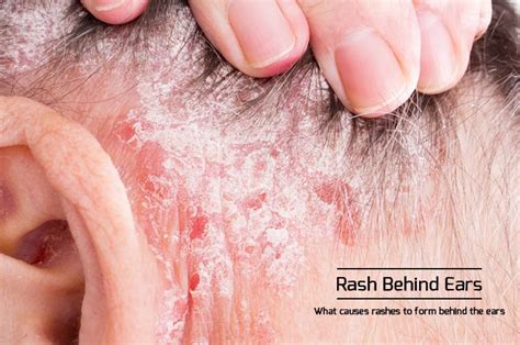 Rash Behind The Ear - Causes & Other Symptoms of Rash On Neck & ears