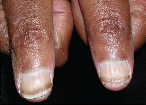 Fingernails - Ingrown fingernails - Dark Line - Fingernail Pain