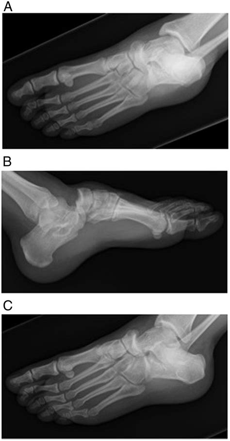 Injury radiographs demonstrating dorsal transverse tarsal joint... | Download Scientific Diagram