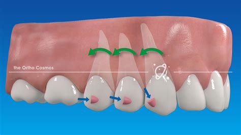 Traditional Attachments vs Aligner Optimization - The Ortho Cosmos