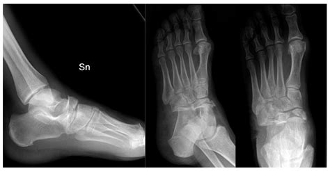 JFMK | Free Full-Text | The Use of Low-Profile Angular-Stability Plates in a “Nutcracker” Tarsal ...