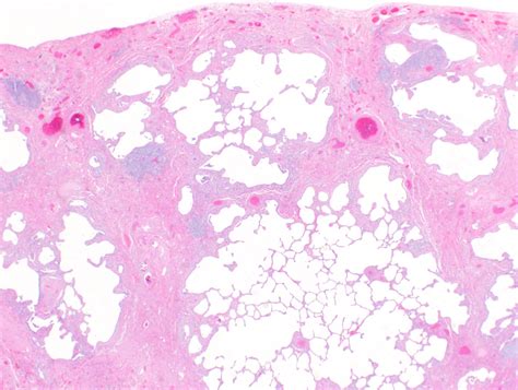 Interstitial Pneumonia Histology