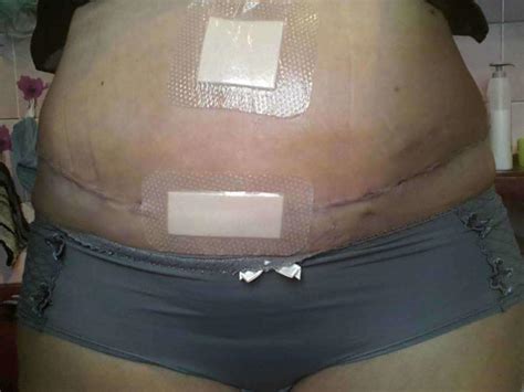 Tummy tuck scarring (2) » Tummy Tuck: Prices, Photos, Reviews, Info, Q&A