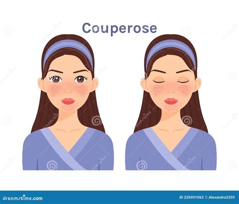 Couperose.Skin Disease on Beautiful Face. Treatment. Woman with Open Eyes and Closed. Stock ...