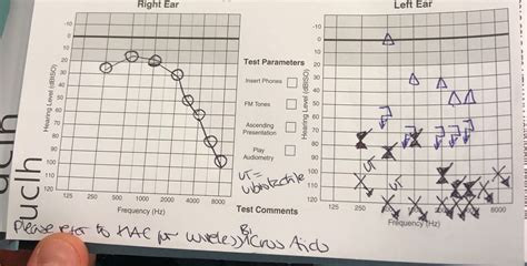 Need help understanding my Audiogram - Hearing Loss - Hearing Aid Forum - Active Hearing Loss ...