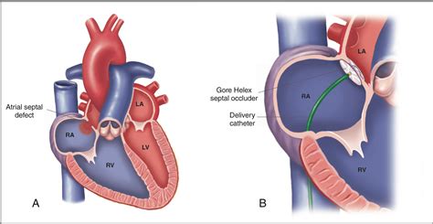 Long-Term Complications After Congenital Heart Defect Repair - Off the Charts