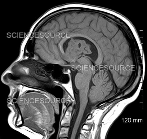 Photograph | Brain Subependymoma, Sagittal T1 weigh | Science Source Images