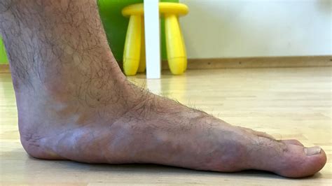 5 Ways to Treat Flat Feet - Impulse Today