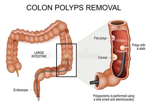 Colon Polyps Removal. Colonoscopy and Polypectomy Stock Vector - Illustration of tumor, anus ...