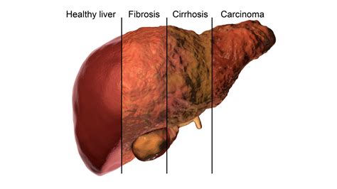 Fatty Liver Disease Program | Los Angeles - Southern California Multi ...