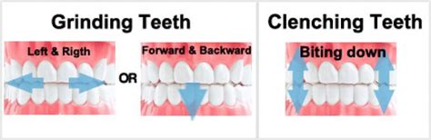 How to Stop Teeth Clenching