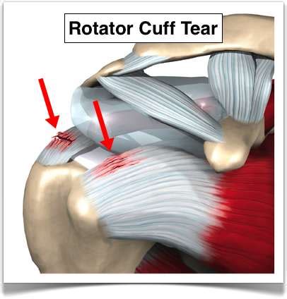 Rotator Cuff Tear MRI Images and Interpretation | New Health Advisor
