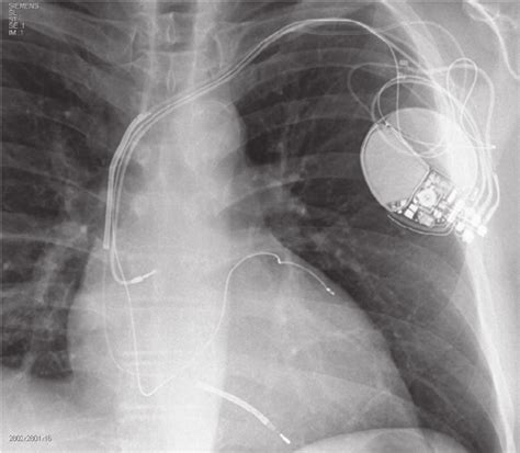 Chest X-ray showing implantation of 3 leads including a left... | Download Scientific Diagram