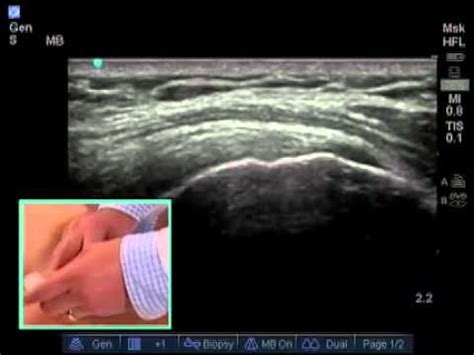 How To: Ultrasound Guided Shoulder Injection Scanning Technique Video - YouTube