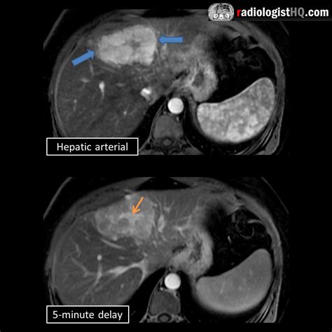 Focal nodular hyperplasia on contrast-enhanced MRI : r/Radiology