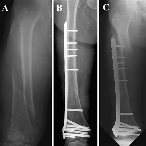 (A) Radiograph of a distal femur fracture after a ground-level fall ...