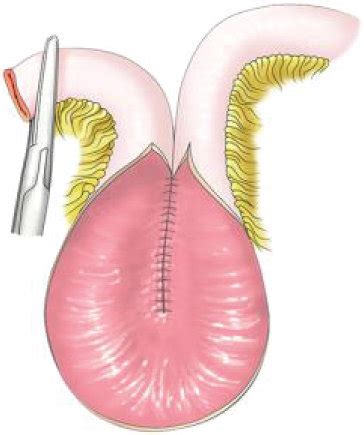 Construction of a Kock pouch reservoir. | Download Scientific Diagram