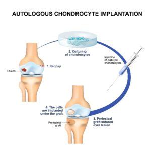 Knee Cartilage Transplant Procedures Chillicothe OH - Knee Pain Treatment