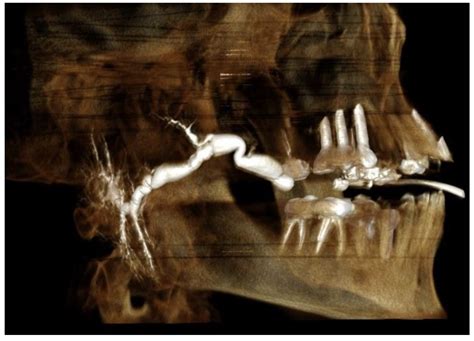 Diagnostics | Free Full-Text | Anatomical Features of the Parotid Duct in Sialography as an Aid ...