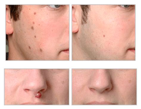 How Does Laser Mole Removal Work - 2024 Guide - Ferguson Action 2024