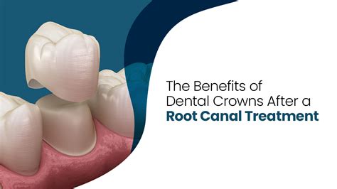 5 Benefits from Dental Crown After Root Canal - Springvale Blog