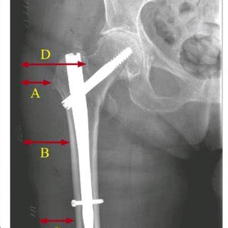 Three main types of hip fractures: femoral neck fracture (subcapital ...