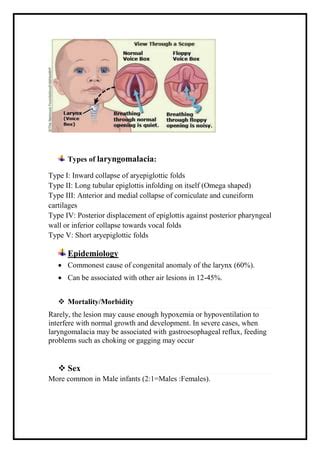 Laryngomalacia: What Is It, Symptoms Treatment, 54% OFF