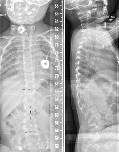 2 view Spine films demonstrating a dextroconvex curvature of the... | Download Scientific Diagram