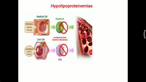 Hypolipoproteinemia - YouTube