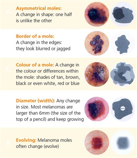 Malignant Melanoma Symptoms - Doctor Heck