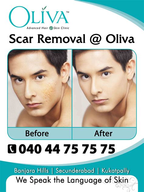 Scar removal can be done at Oliva advanced skin and hair clinic. With the affordable cost. Skin ...