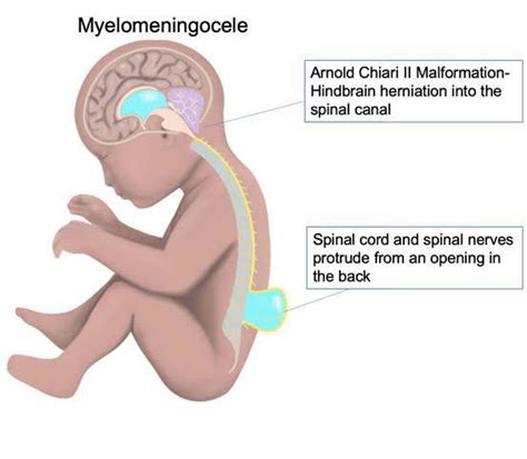 Treatment of myelomeningocele - MEDizzy