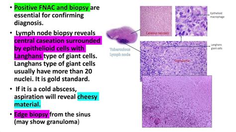 Tuberculous lymphadenitis,cervical lymphadenitis Treatment diagnosis ...