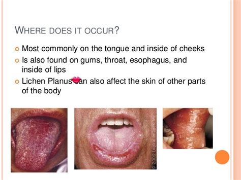 Oral lichen planus