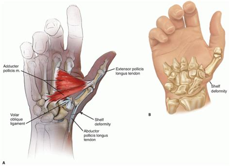 Operative Treatment of Thumb Carpometacarpal Joint Fractures | Musculoskeletal Key
