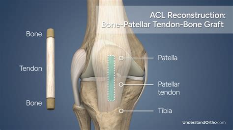 Torn ACL Reconstruction (BPTB Graft) – UnderstandOrtho™