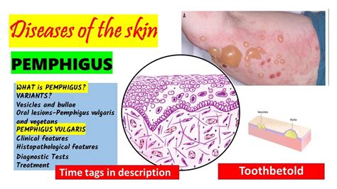 Pemphigus Vulgaris | HISTOPATHOLOGY | Immunofluorescence | Treatment ...