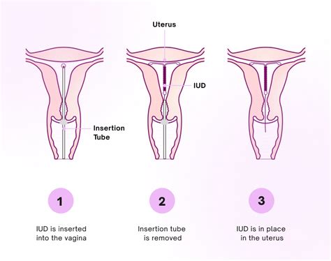 What it feels like to get an IUD | Natural Cycles