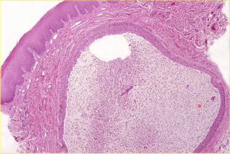 Necrotizing Sialometaplasia Histology