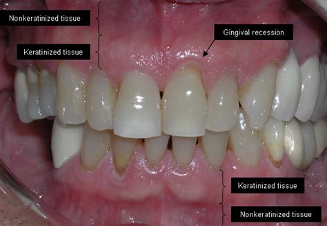 Chronic Periodontitis: Causes, Symptoms & Treatment