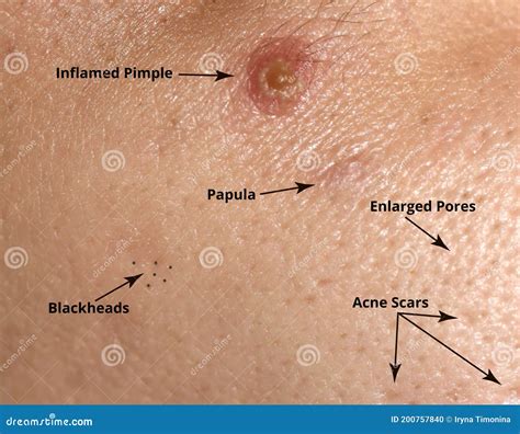 Types of Acne and Acne on the Skin. Enlarged Pores, Inflamed Pimple ...