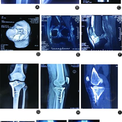 A1, Anteromedial tibial plateau fracture. A2, anterior medial approach... | Download Scientific ...