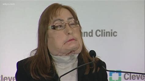 Cleveland Clinic doctors remember first face transplant patient | wkyc.com