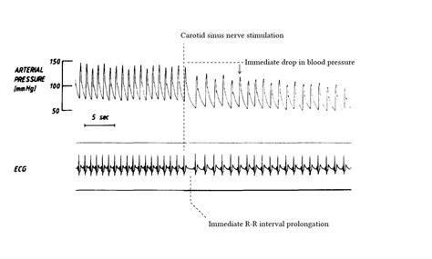 Function of baroreceptors and clinical relevance of the baroreflex | Deranged Physiology