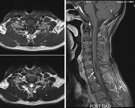 Radiodiagnosis - Imaging is Amazing-Interesting cases: Syrinx - MRI