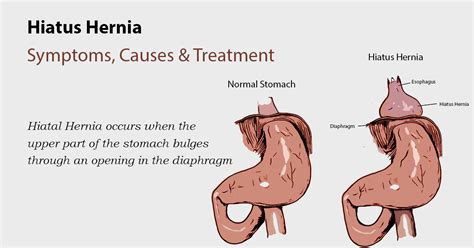 Hiatal Hernia