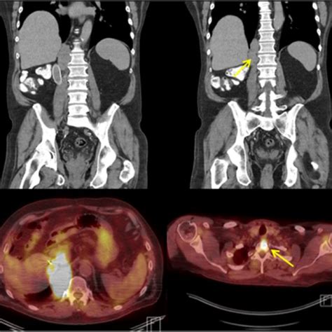 (A) Surveillance CT scan demonstrating retrocrural recurrence... | Download Scientific Diagram