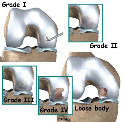 Osteochondritis Dissecans of the Knee | eOrthopod.com